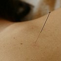 acupunctuur naald